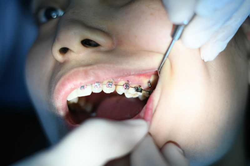 Wisdom Teeth Removal: The Worst Day Explained

