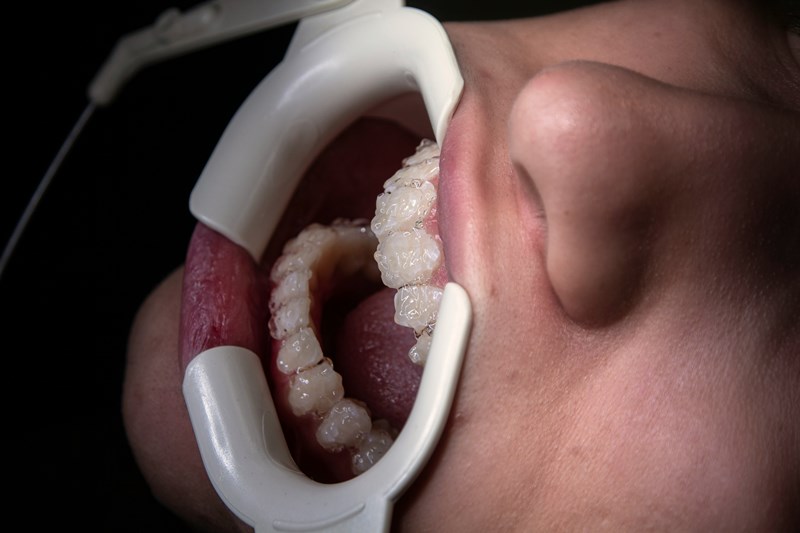  Wisdom teeth removal