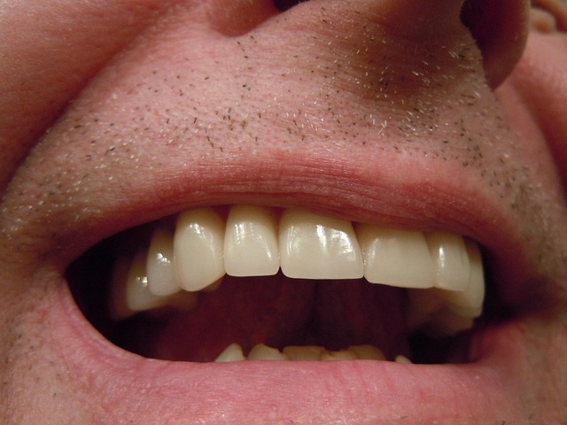 Ceramic Teeth Caps: Top Choice for Dental Restoration